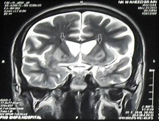 mri caudate pt T2.jpg